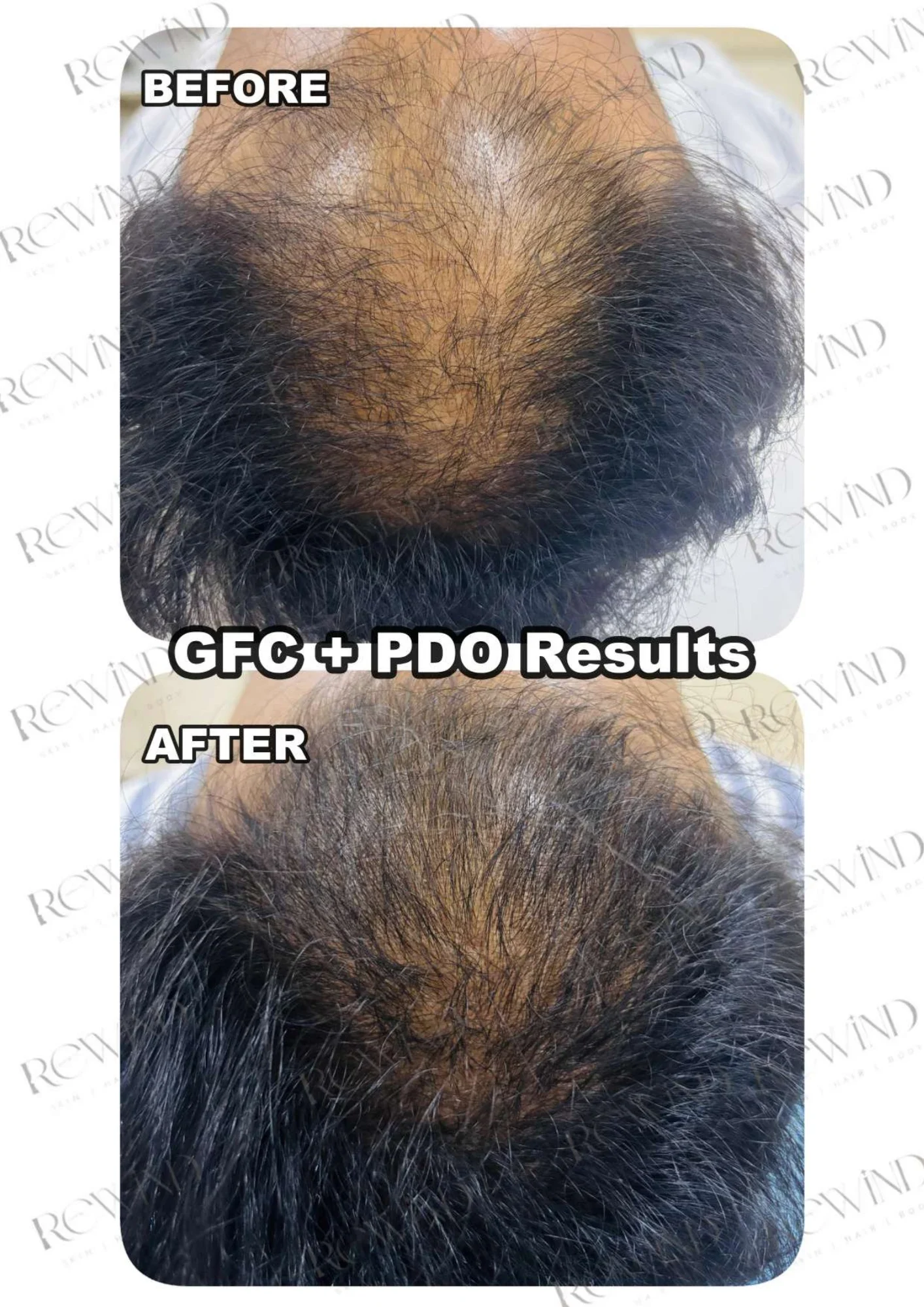 PRP Hair Treatment – Case 01