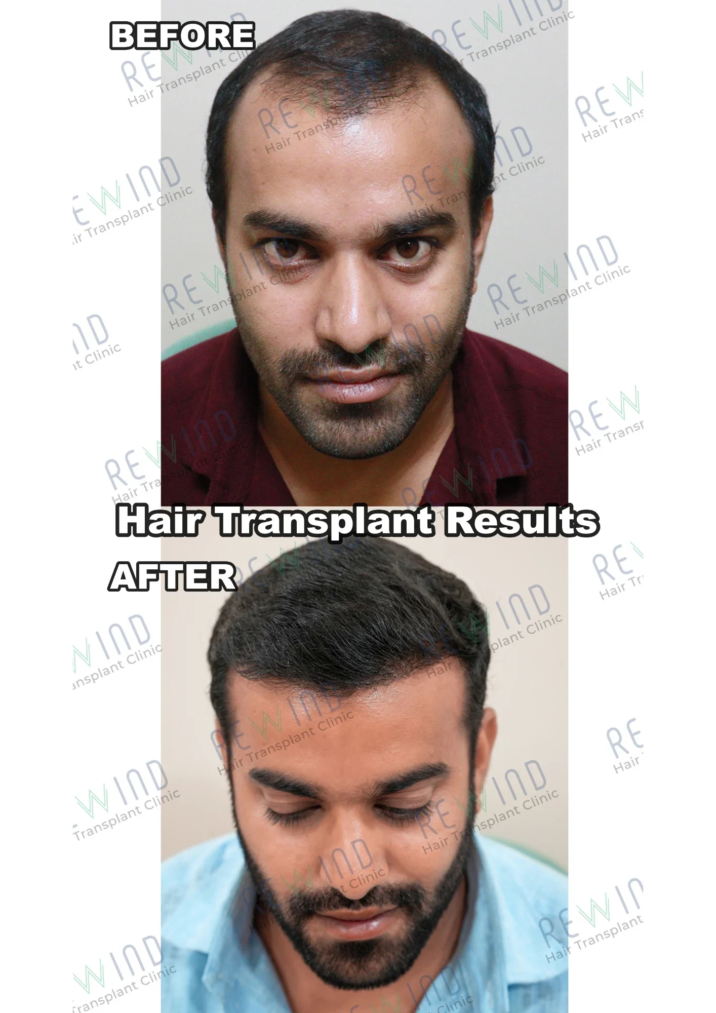 Hair Transplant Result – Case 02