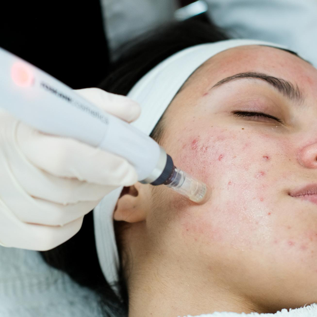 LASER-ACNE-TREATMENT-VIZAG